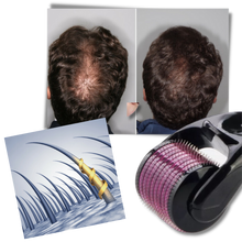 Carica l'immagine nel visualizzatore di Gallery, Rullo Derma per la crescita di capelli e barba - Ozerty

